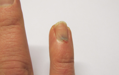 gequetschter Finger
